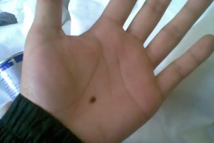 会影响你的运势,下面我们来看看手心有痣好不好,男人和女人的寓意不同