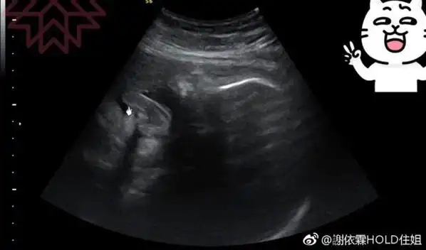 谢依霖拍b超发现孩子在吐舌调侃宝宝不尊重人