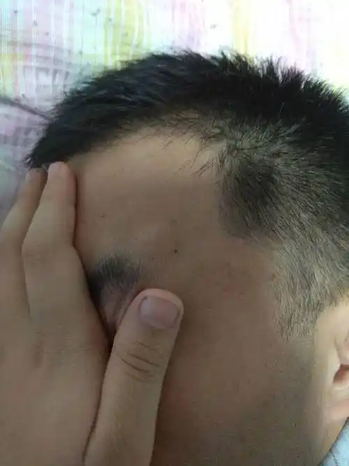 面部粉瘤(皮脂腺囊肿)去医院挂号应该挂哪个科?