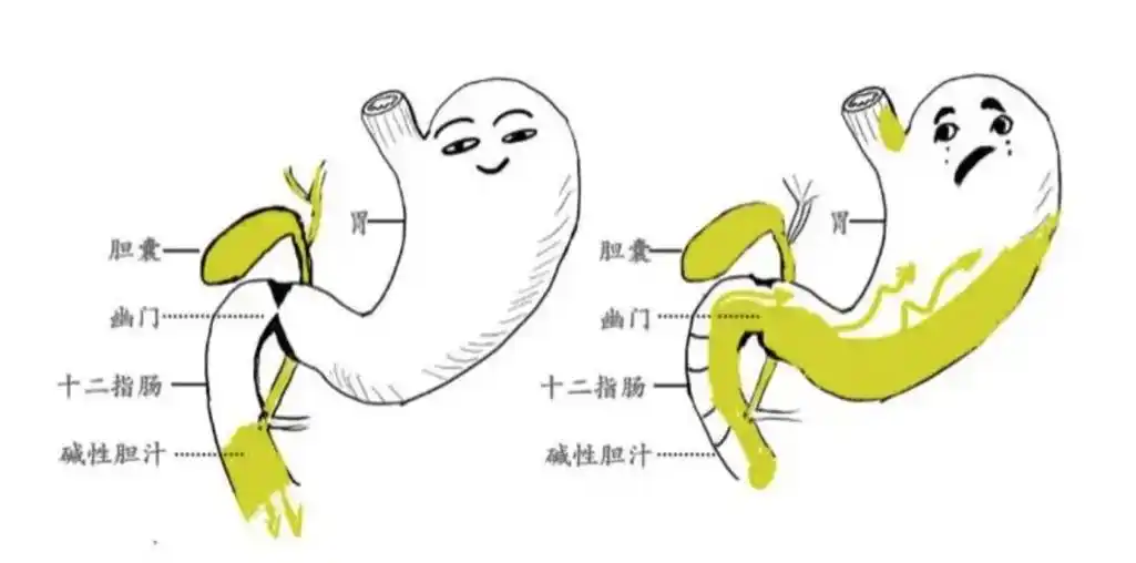 什么是慢性胃炎胆汁反流?