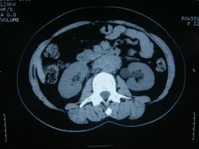看图讨论一例肾积水病人