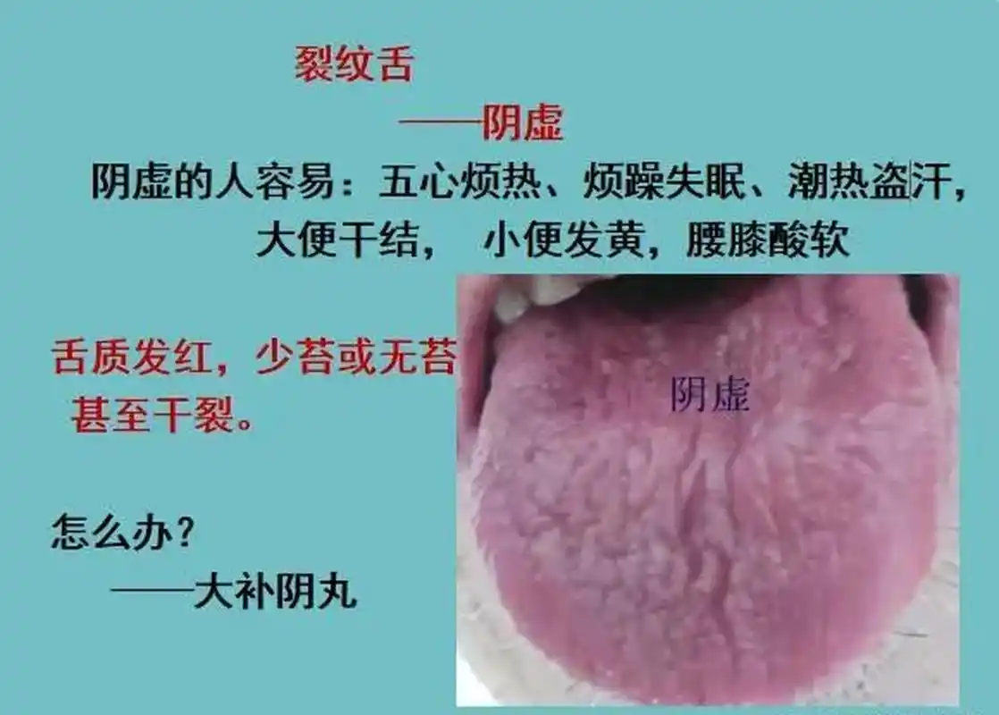 裂纹舌,舌头伸出来,有一条一条很深的裂纹,而且有的是舌前裂,有的是舌