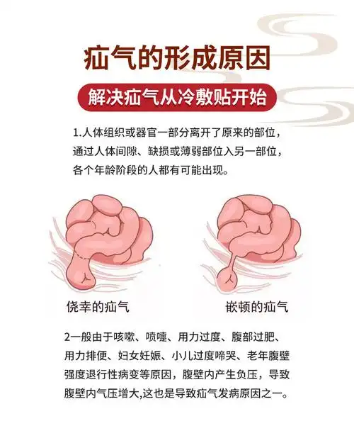疝气贴膏脐疝老人中老年腹股沟男性女性肚脐贴疝气带jw一周期装m