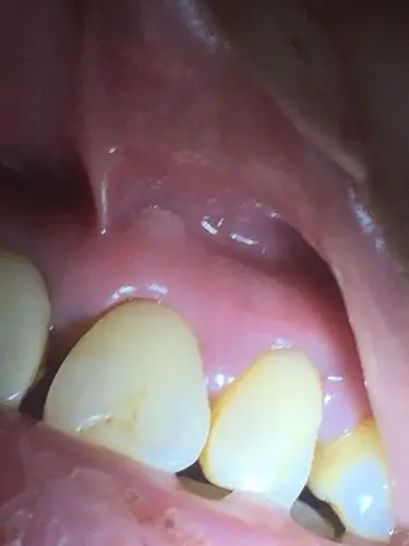 牙龈上有一块白,一碰就疼连带着牙齿也疼,这是什么毛病