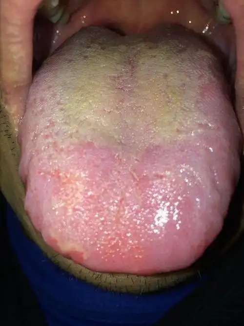 脾胃好不好舌头舌苔有信号这几种食物健脾调理老胃病