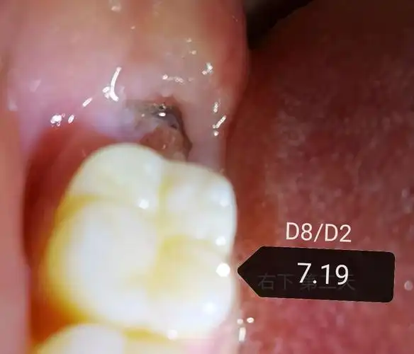 拨过智齿的亲们,你们的拨牙窝是怎样长平的? - 知乎