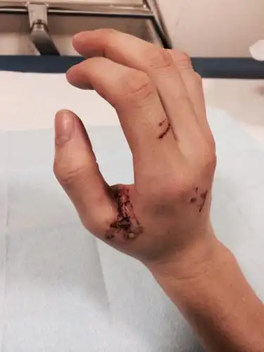 手上缝针十天了 明天就要去拆线了 但是刚刚自己清理伤口的时候感觉肉