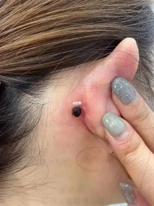 耳朵后面的色素痣