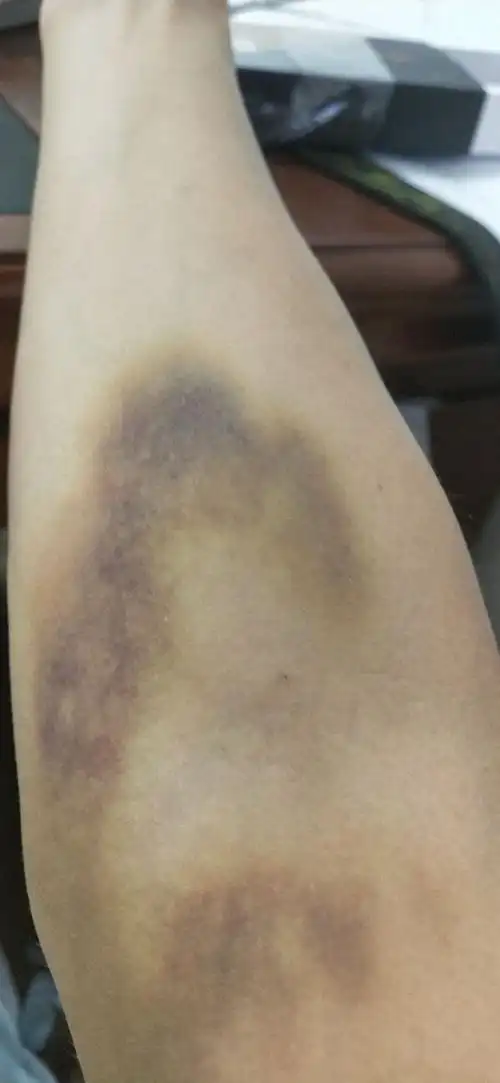 贴一张献血后手臂青紫的图免得有人说我在编故事