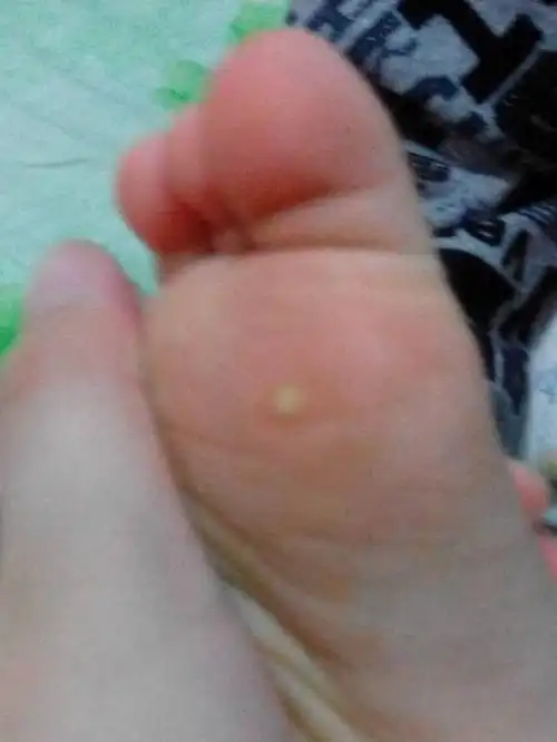 两岁宝宝脚底起了个白色的豆豆,想知道是什么?能不能自己愈合