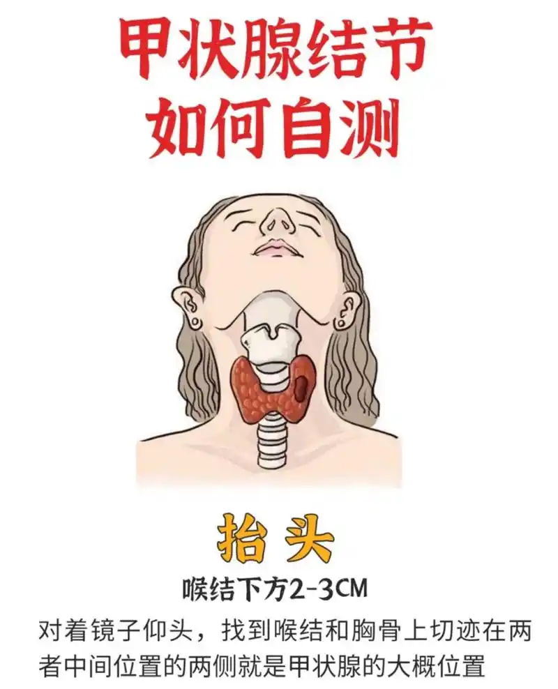 甲状腺结节自测!你的甲状腺还好吗!