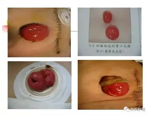 造口的护理要点