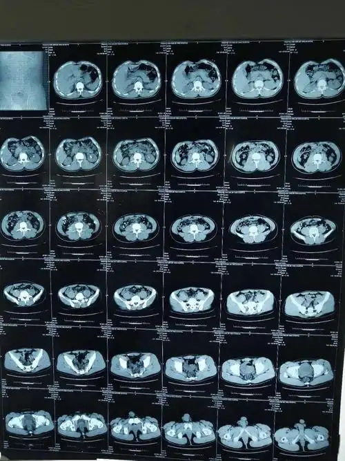 左肾结石彩超,ct检查情况2患者目前病情可考虑行经皮肾镜肾结石碎石