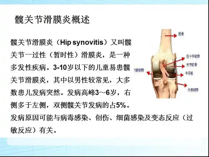 髋关节滑膜炎ppt课件ppt