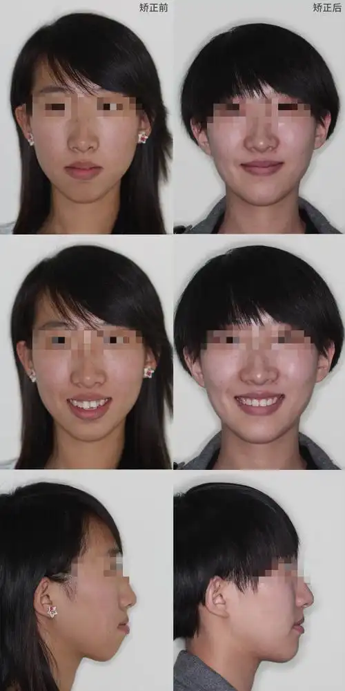 栗子的五官属于是精致小巧型,脸型也是偏瘦长,跟五官比较搭配,遗憾的