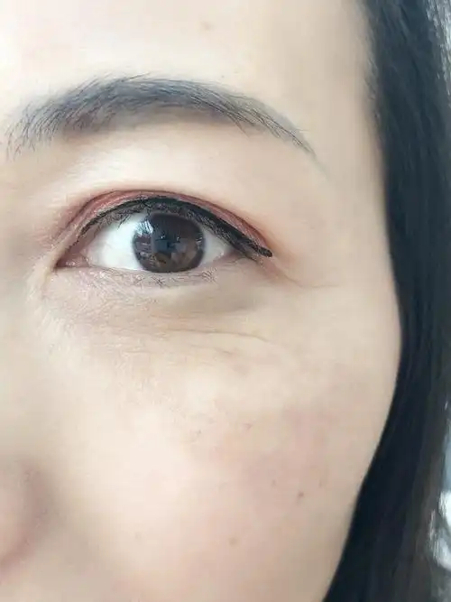 各位大佬们,麻烦帮忙看看这种眼底皱纹要做什么手术去除?