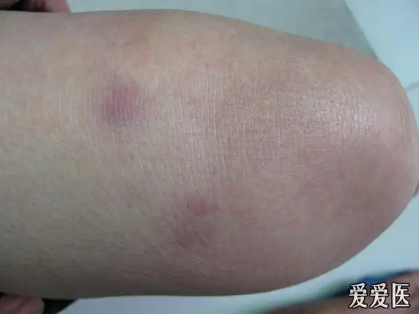 皮下痛性结节---结节性红斑(未病检) - 皮肤及性传播疾病讨论版