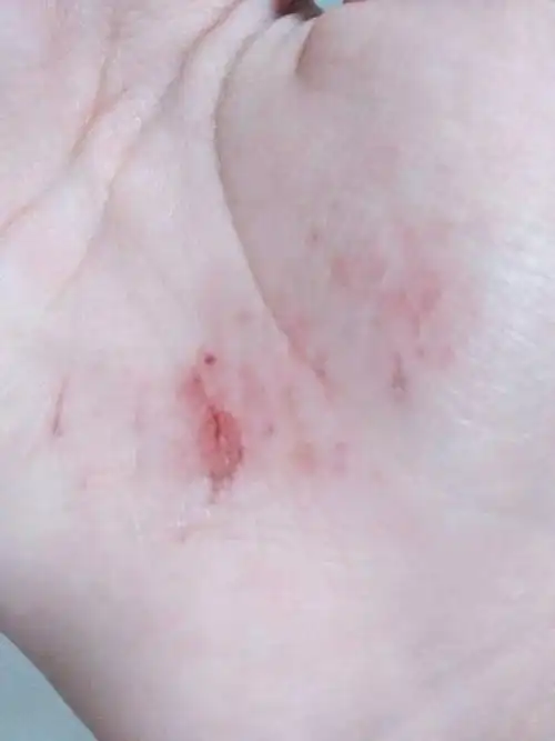 本人今天跑步手不小心擦伤,特别疼,但是明天还要考试,写字特别多,怎么