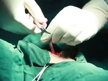 想不到女人做结扎手术还有这好处