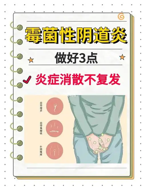霉菌性阴道炎做好3点炎症消散不复发75
