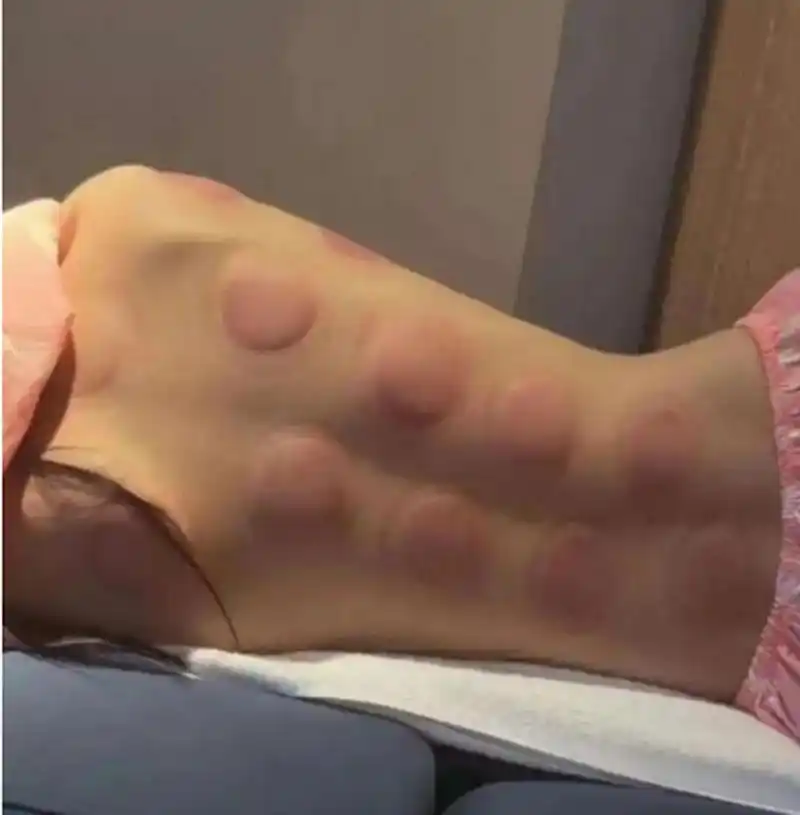 再好看的后背,拔罐之后也是一样的.