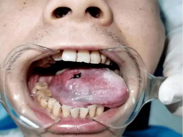 槟榔加烟,法力无边?错,是口腔癌变!