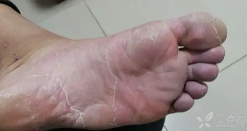 请问脚底发紫是怎么回事呢?