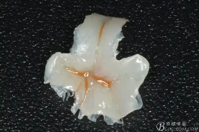 树脂嵌体-简约不简单