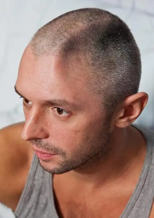 英男子阳台坠下致四分之一头盖骨被切除