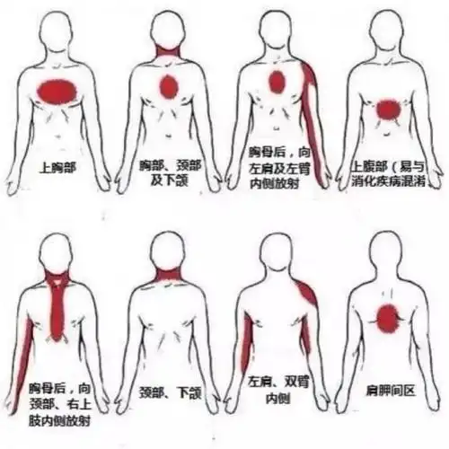 陈建平主任教你识别心绞痛!