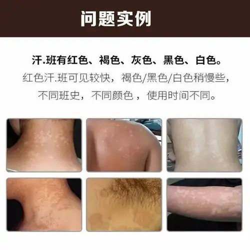 【京东大药房】汗斑癣专用花斑癣白斑癣红斑克星汗斑净花斑专用露皮肤