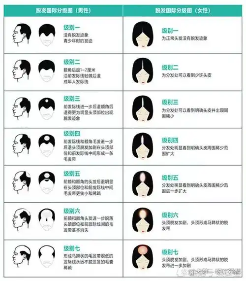 脱发也分级?赶紧照照镜子,1分钟自检