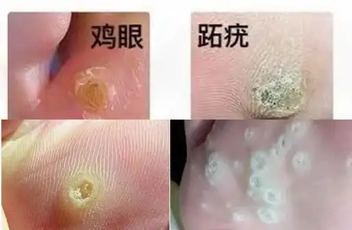 跖疣初期图片鸡眼和跖疣怎么辩对比图