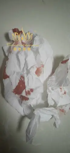 其它 划伤,大量流血愈合全程 写美篇9.12凌晨搞卫生, 被马桶金属划伤