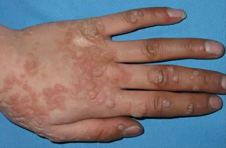 【病毒疣】疣的临床表现及其分型,图片