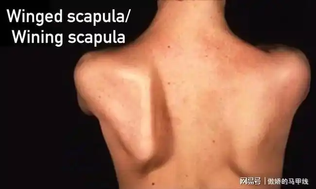 这两个翘起来的肩胛骨就是我们今天的主角:翼状肩胛(winged scapula)!