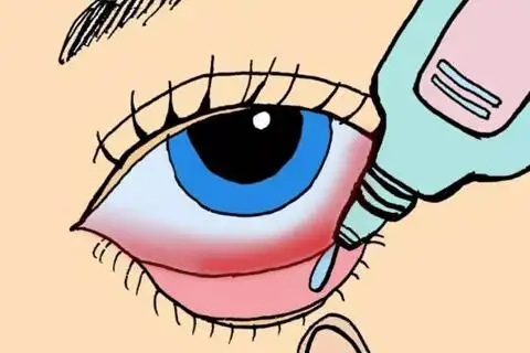 急性结膜炎可导致角膜炎,继发性泪道阻塞等并发症.