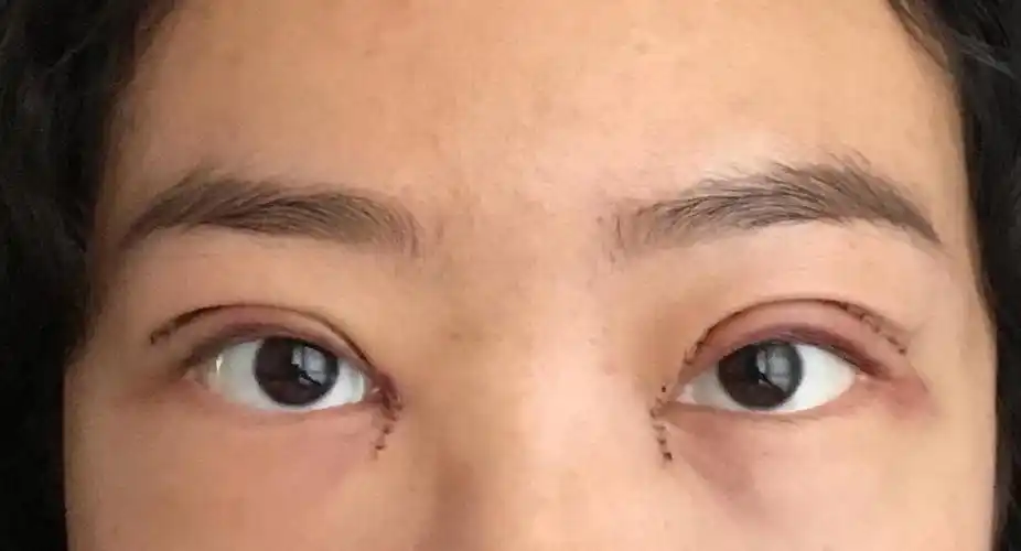 术后恢复贴内双肿泡眼严重内眦赘皮全切开内眼角930手术