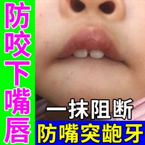 孩子老吸下嘴唇怎么办 怎么改掉宝宝咬下嘴唇妙招