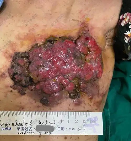 晚期乳腺癌_乳腺癌 - 好大夫在线