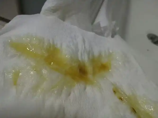 急急急请问这是什么病啊,刚才感觉想放屁,结果蹲厕