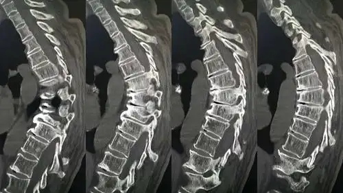 术前胸椎ct失状面三维重建