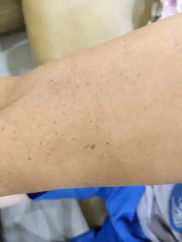 这是什么斑?怎么消除?连手臂都有!