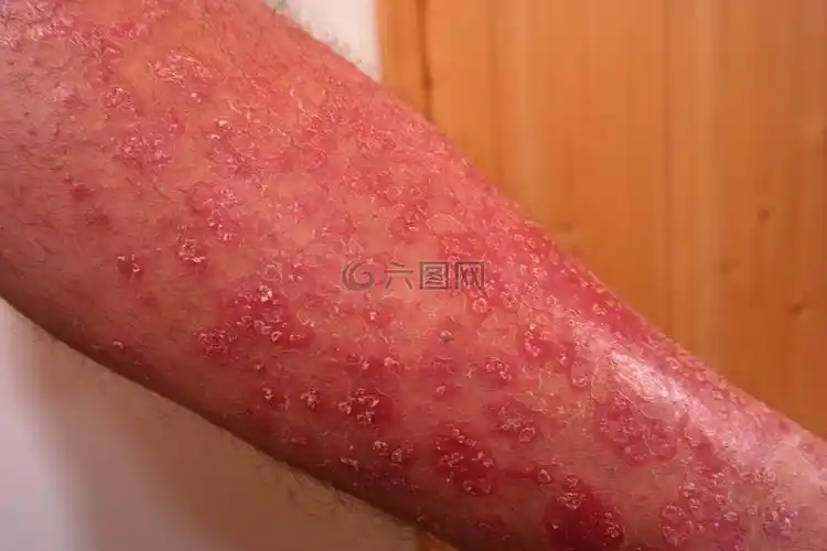 银屑病,皮肤病,红色