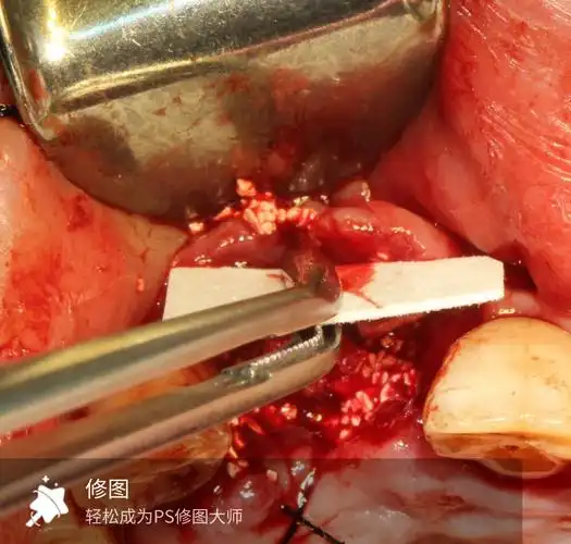 中切牙植骨种植修复