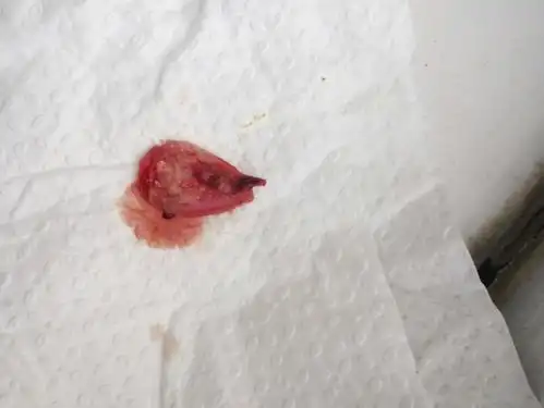 怎样发帖今天本来要做流产手术,结果在医院卫生间上厕所脱落出一个