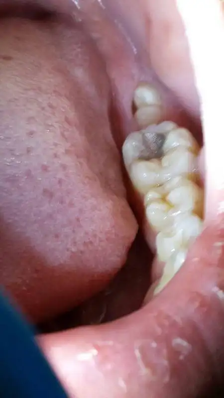 智齿,是人类口腔内牙槽骨上最里面的第三颗磨牙,也是萌出最晚的磨牙