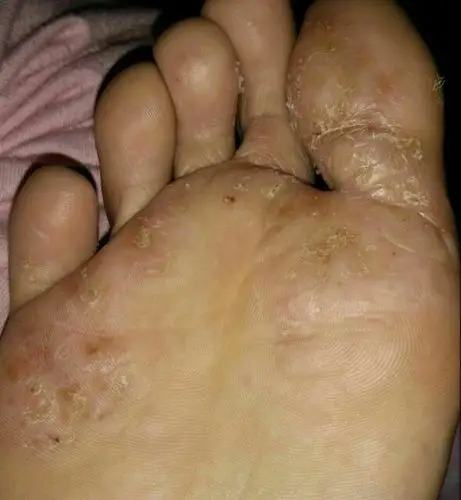 脚起水泡还发痒怎么办啊?谁有办法?跪求!