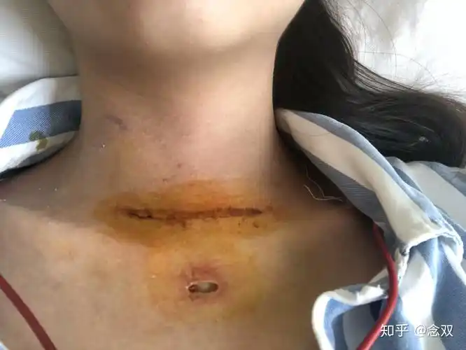 记录一下我的甲状腺手术