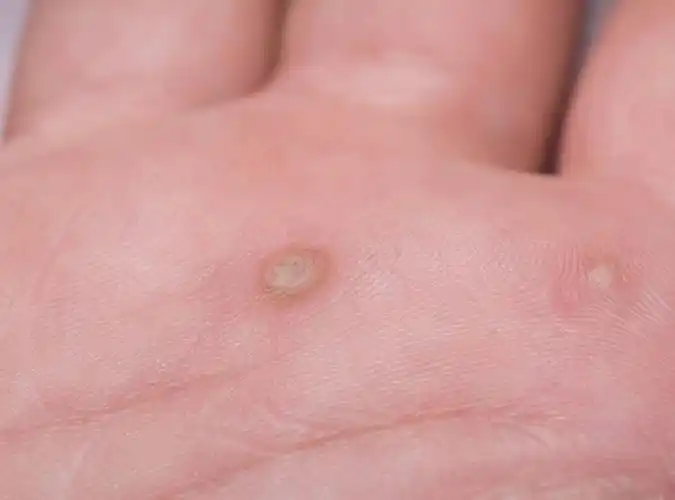 手上的瘊子竟然和hpv有关系?